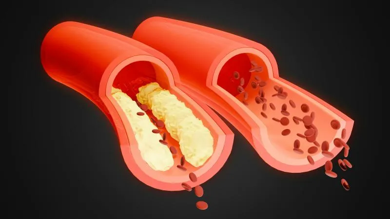 Coronary Angioplasty