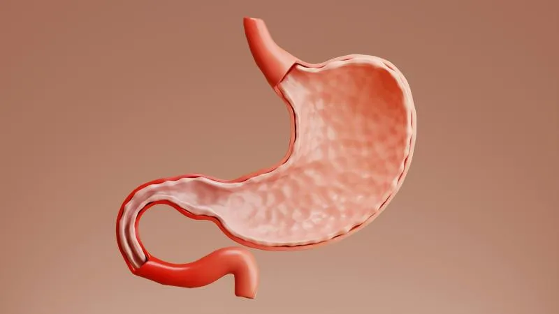 Sleeve Gastrectomy - Stomach Sleeve Surgery