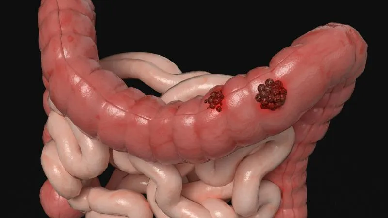 Colon Cancer Surgery