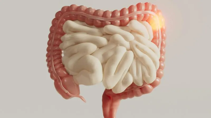Colon Resection - Colectomy