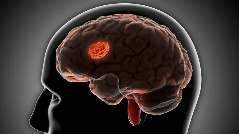 Epilepsy Surgery