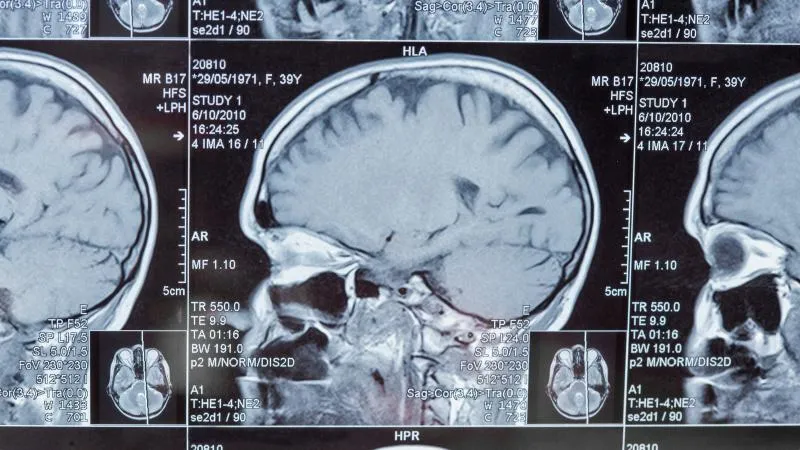 Glioma Surgery