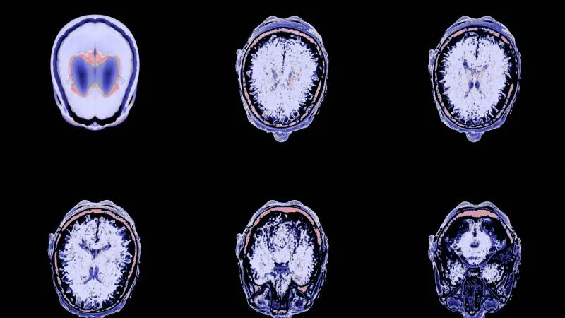 Glioblastoma Surgery