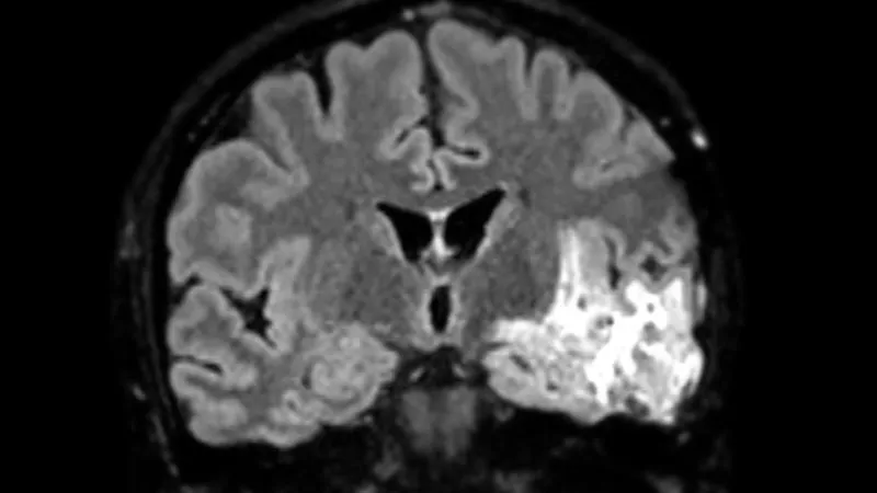 Meningioma Microsurgery