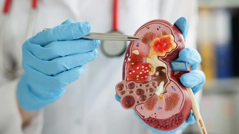 Kidney Cancer Surgery - Renal Cancer Surgery