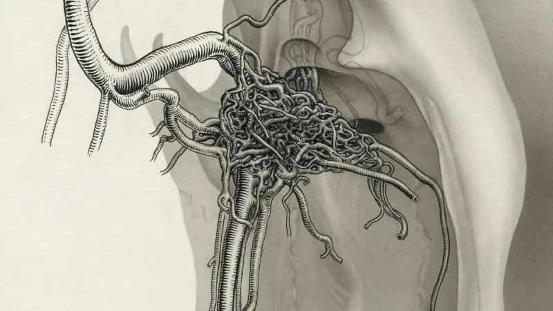 Radical Orchiectomy - Testicle Removal Surgery