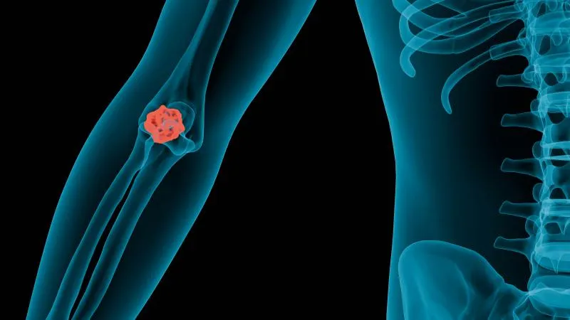 Bone Marrow Transplant For Multiple Myeloma