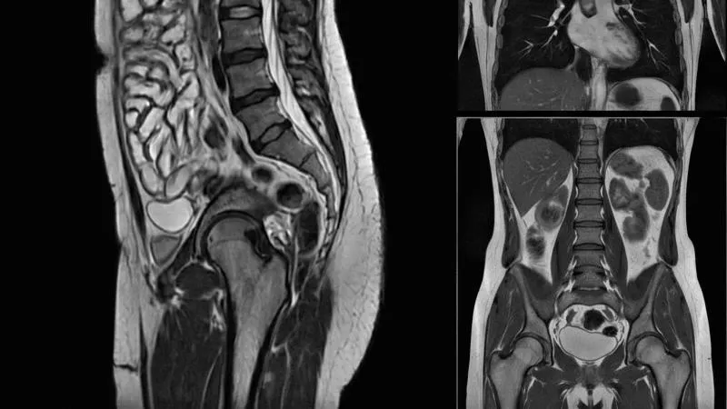 ERCP - Endoscopic Retrograde Cholangiopancreatography