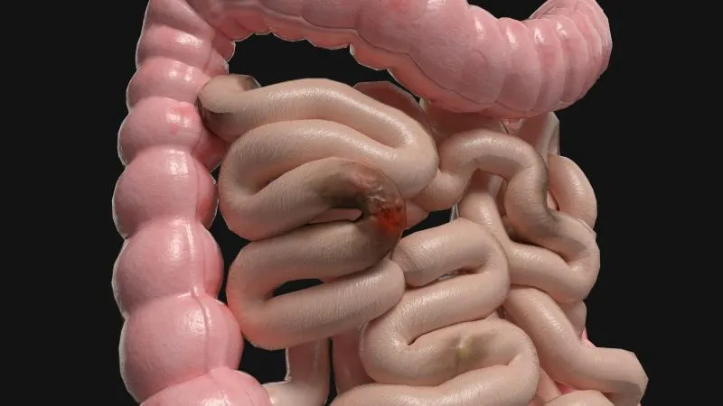 Endoscopic Mucosal Resection - EMR