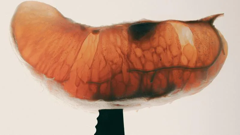 Endoscopic Submucosal Dissection - ESD