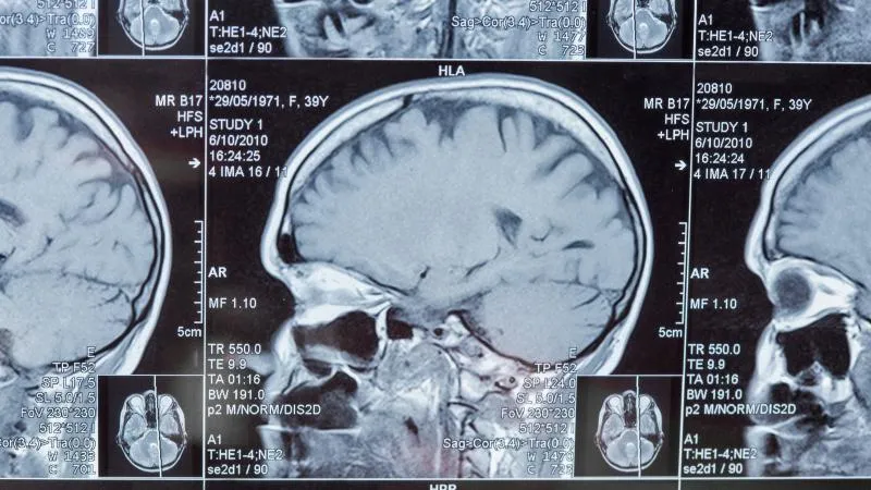 Glioblastoma Radiation Therapy