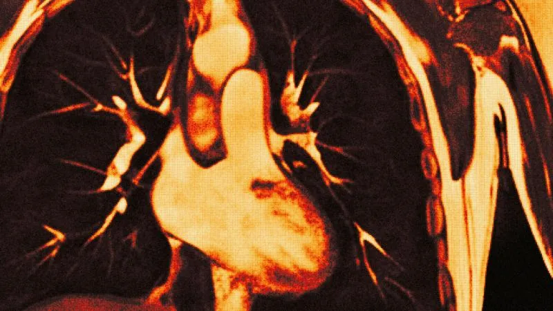 VATS Lobectomy for Lung Cancer
