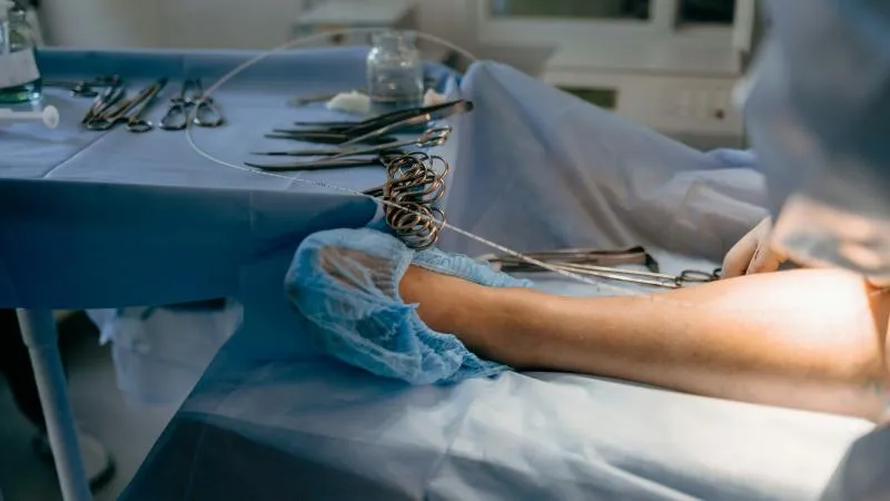 Varicose Vein Treatment