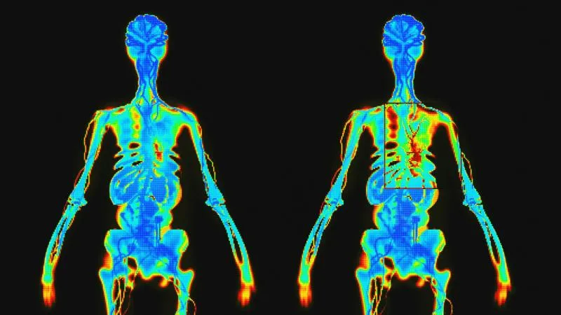 Bone Scan - Bone Scintigraphy