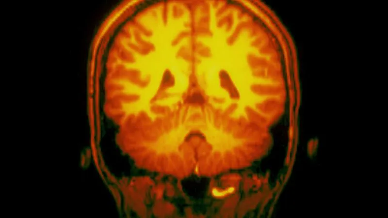 I-131 MIBG Therapy - Radioactive MIBG Treatment