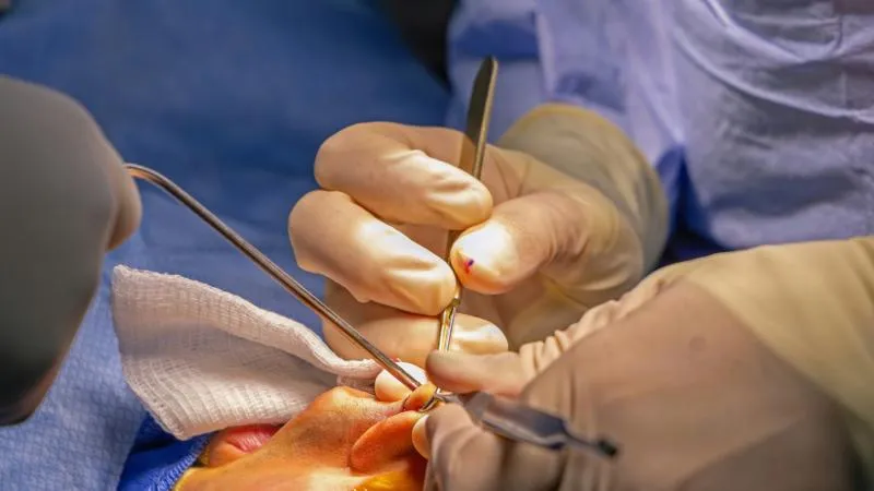 Septoplasty - Deviated Septum Surgery
