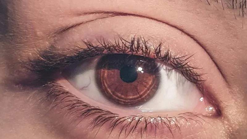 Blepharoplasty - Eyelid Surgery