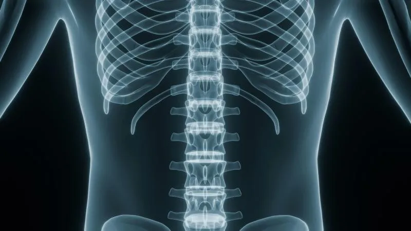 Scoliosis Surgery Child