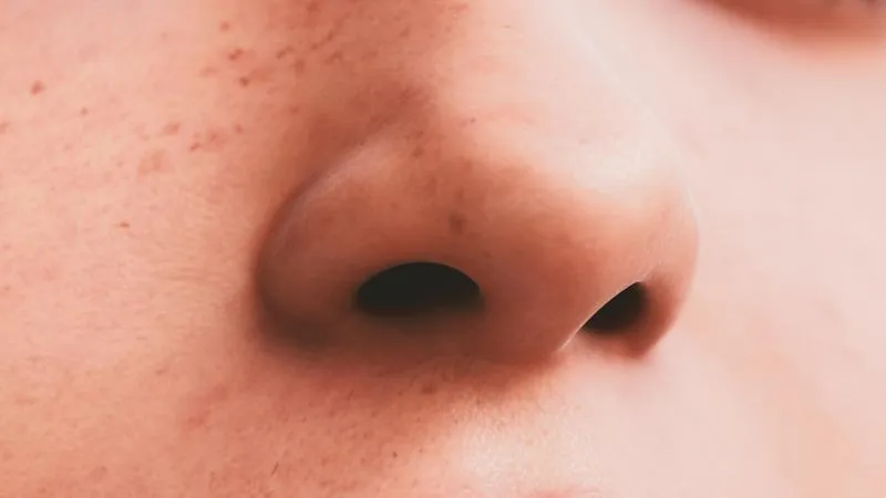 Nasal Polyp Surgery