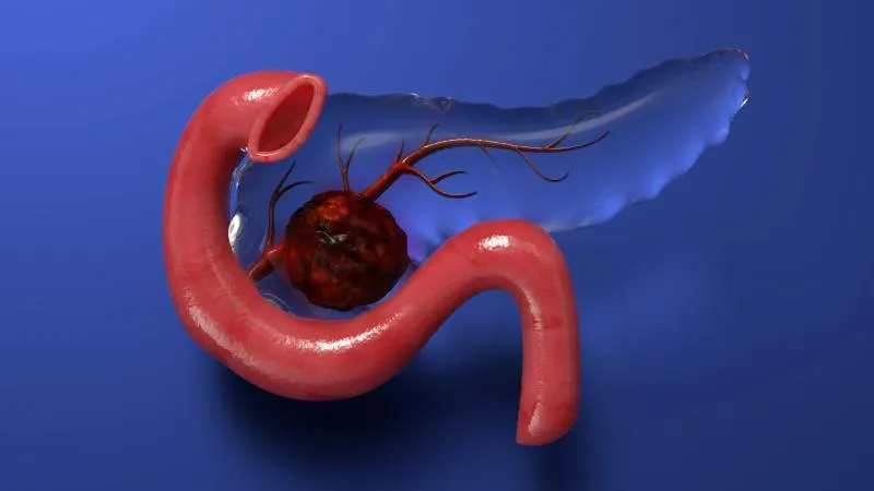 Pancreatic Cancer Surgery