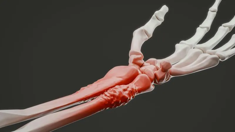 Osteosarcoma - Bone Cancer Removal