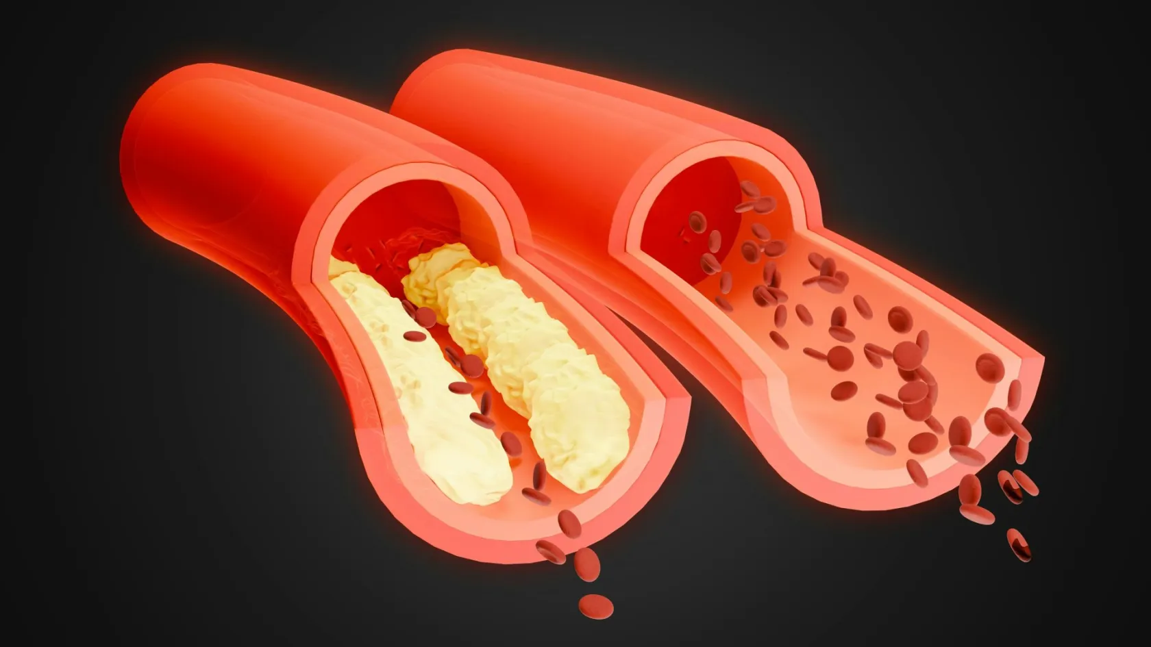 Coronary Angioplasty