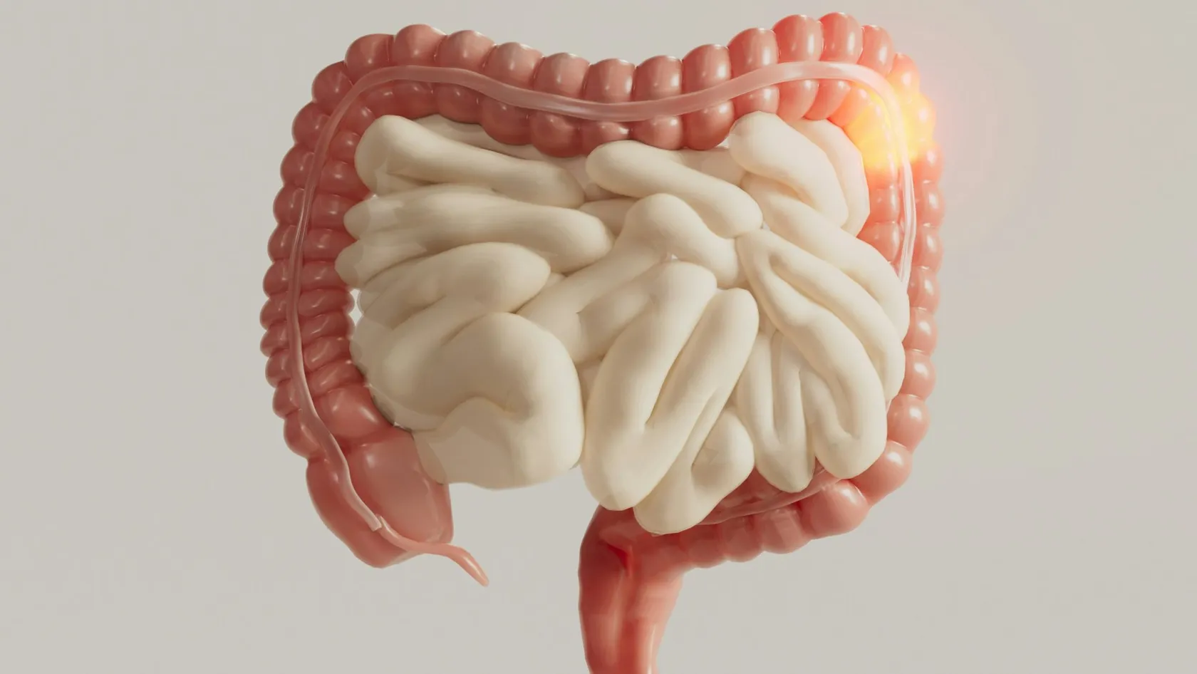 Colon Resection - Colectomy