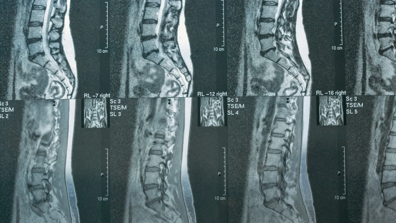 Herniated Disc Removal - Disc Herniation Surgery