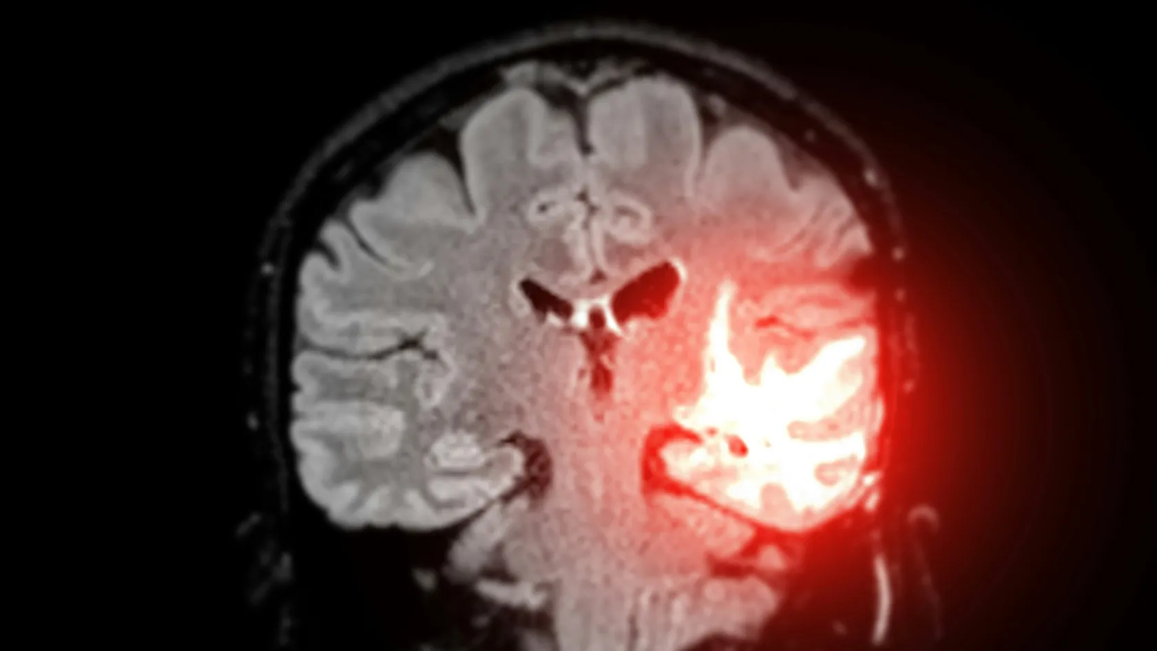 Brain Tumor Surgery - Brain Tumor Removal