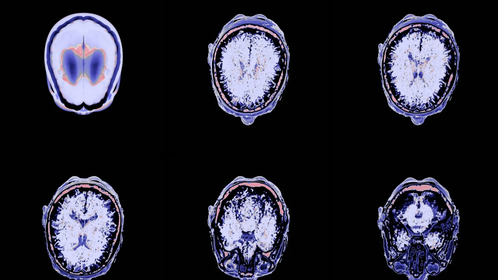 Glioblastoma Surgery