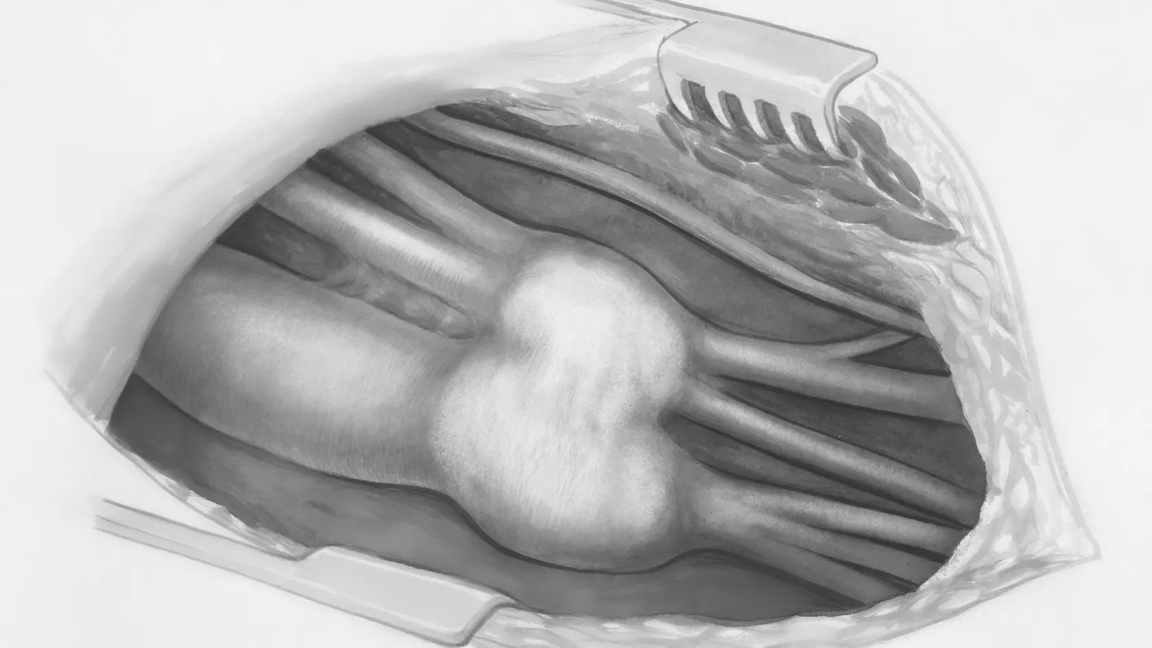 Selective Dorsal Rhizotomy - SDR