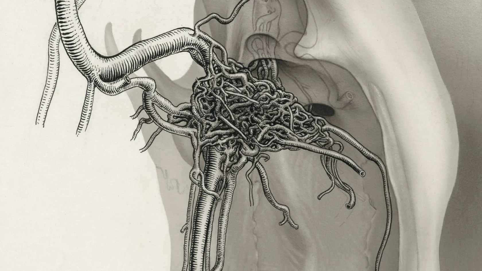 Radical Orchiectomy - Testicle Removal Surgery