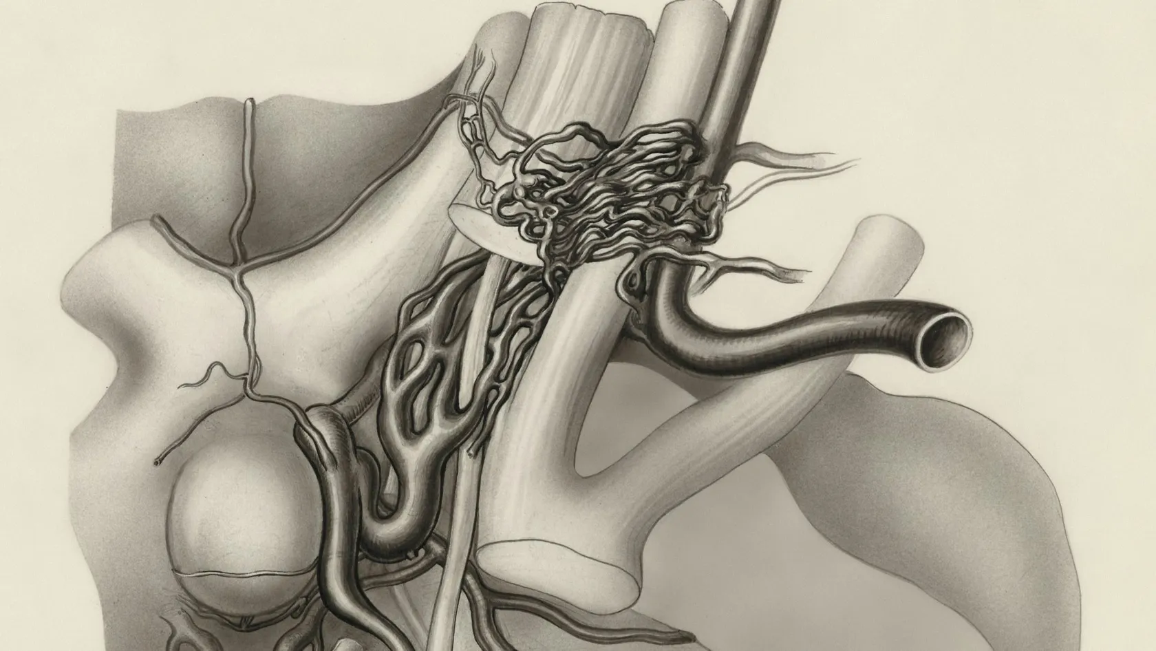 Vasectomy