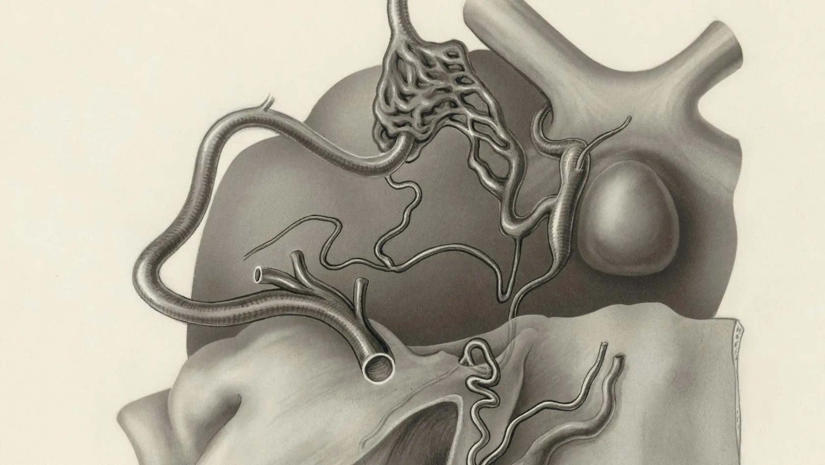 Vasectomy Reversal - Vasovasostomy