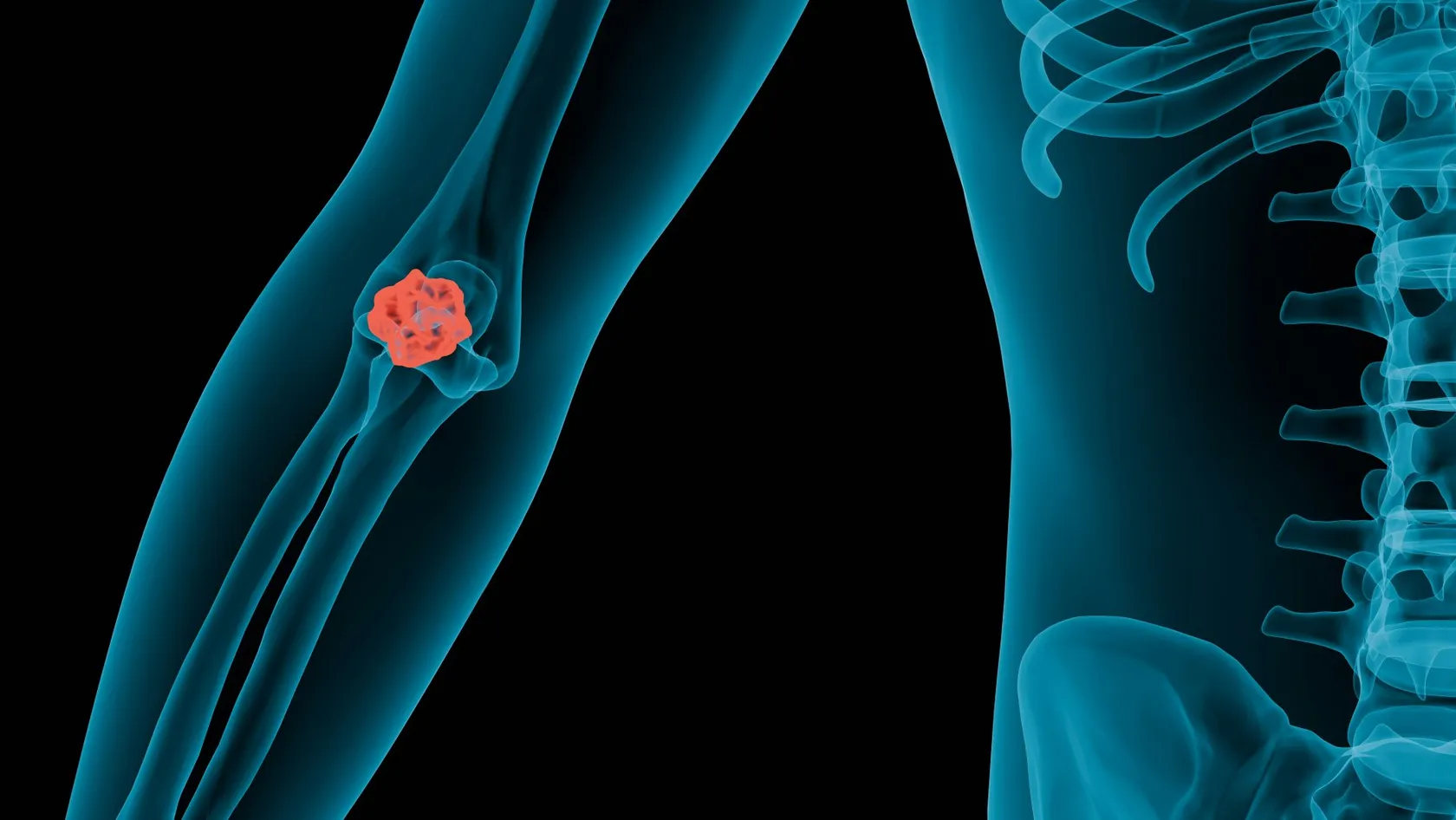 Bone Marrow Transplant For Multiple Myeloma