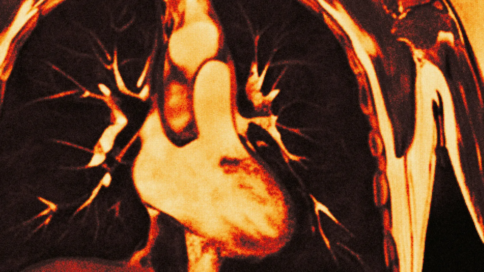 VATS Lobectomy for Lung Cancer