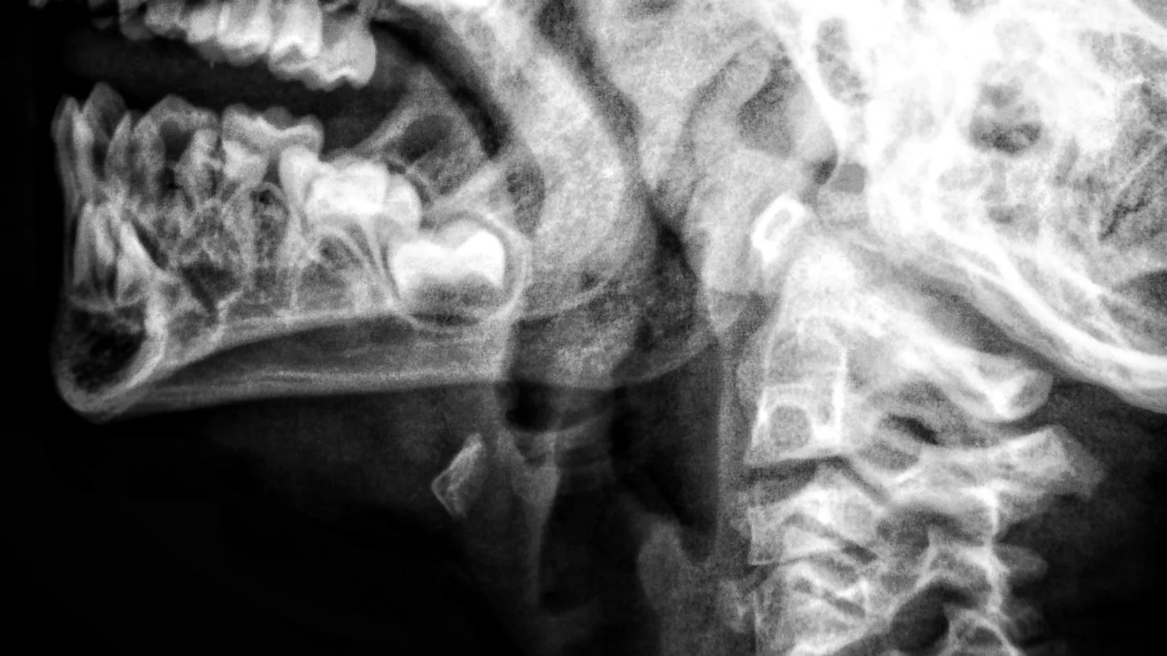 Thyroid Scan - Thyroid Scintigraphy