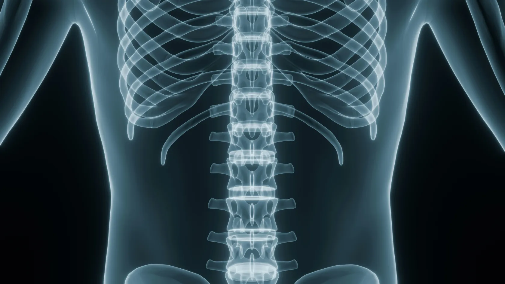 Scoliosis Surgery Child
