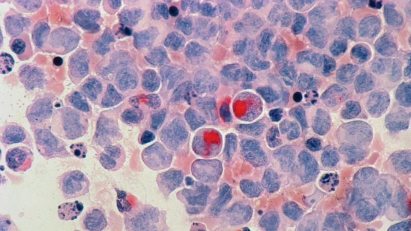 Understanding chronic myeloid leukemia (CML) and modern treatment options