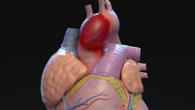 Aortic Valve Replacement