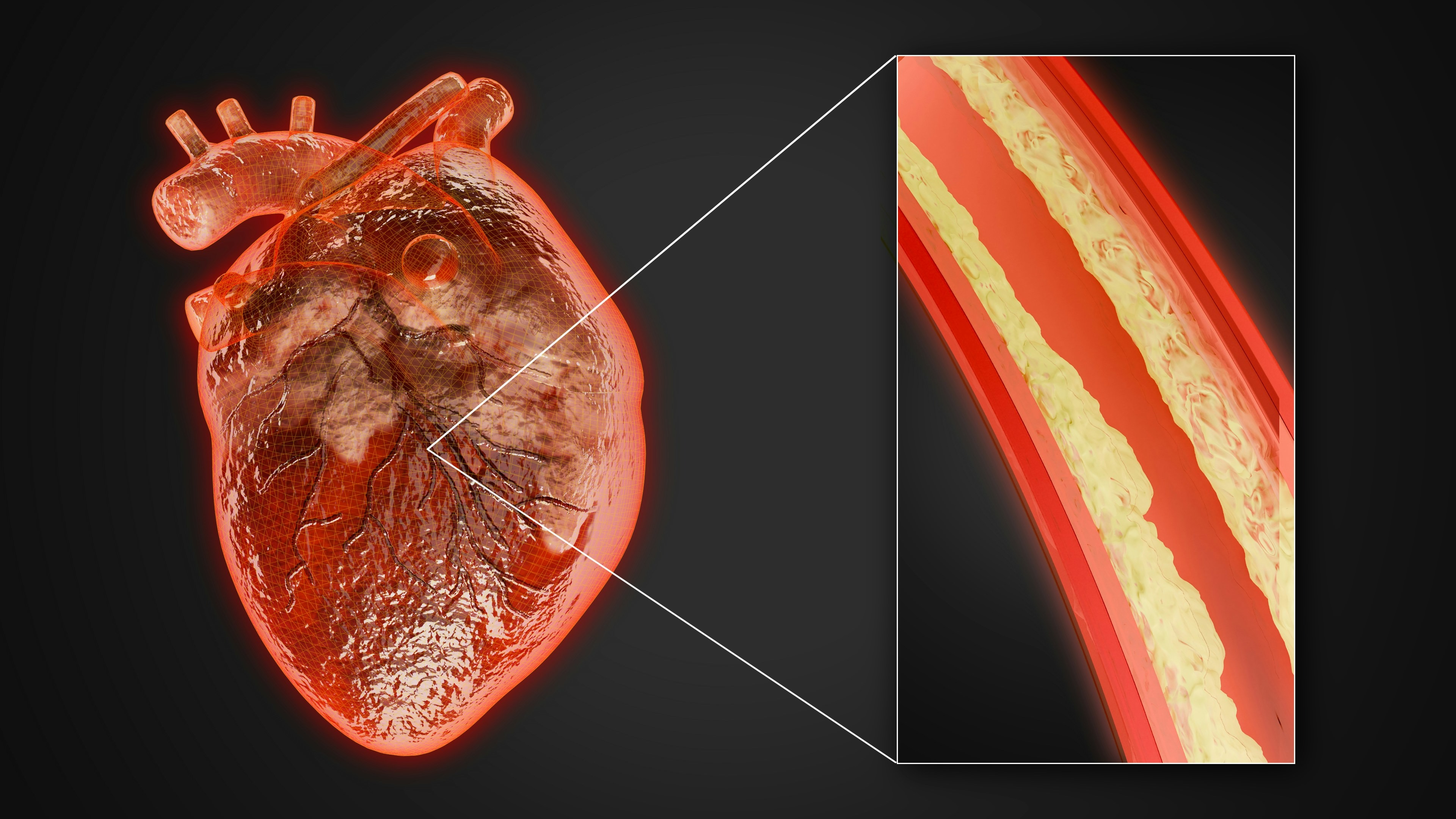 TAVI Surgery Transcatheter Aortic Valve Implantation