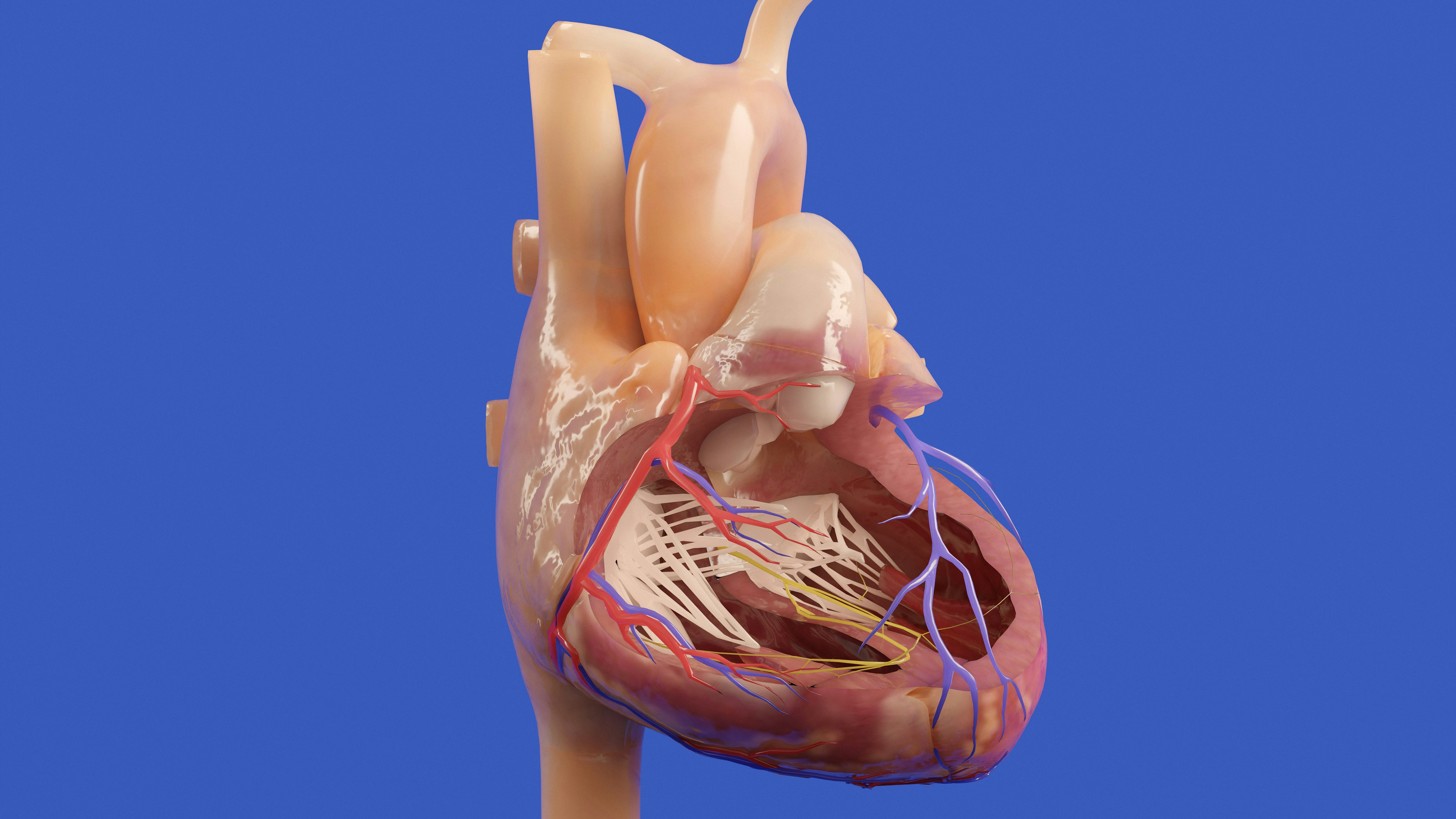 Transcatheter Mitral Valve Replacement (TMVR)