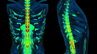Cervical Microdiscectomy - Minimally Invasive Neck Disc Surgery