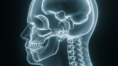 Chiari Malformation Surgery