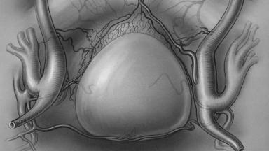 Bladder Cancer Surgery