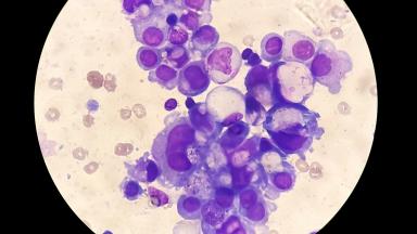 Bone Marrow Transplant For Hodgkin Lymphoma