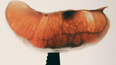 Endoscopic Submucosal Dissection - ESD