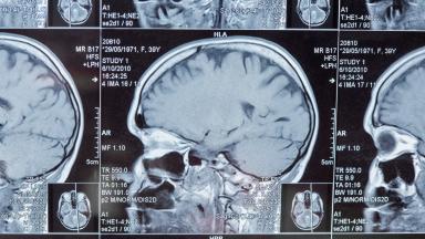 Glioblastoma Radiation Therapy