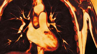 VATS Lobectomy for Lung Cancer