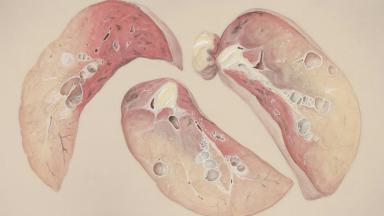 HCC - Liver Transplant For Hepatocellular Carcinoma